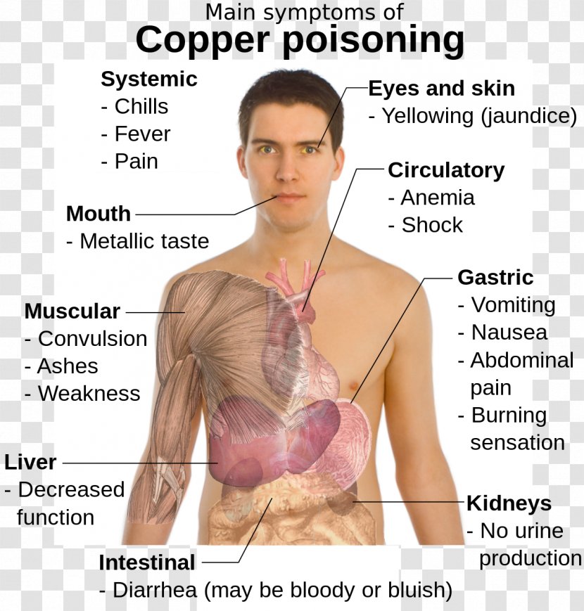 Copper Toxicity Poison Disease Symptom - Cartoon - Iron Deficiency Anemia Transparent PNG