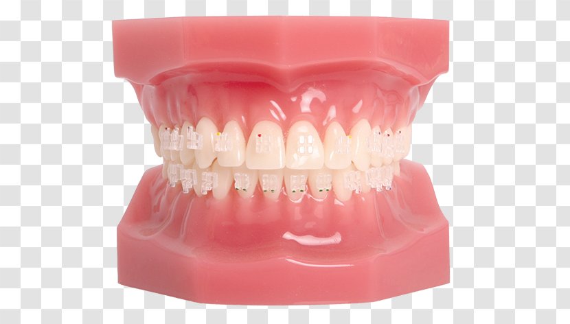 Tooth Dental Braces Orthodontics Splint Maxilla - Mouth Transparent PNG