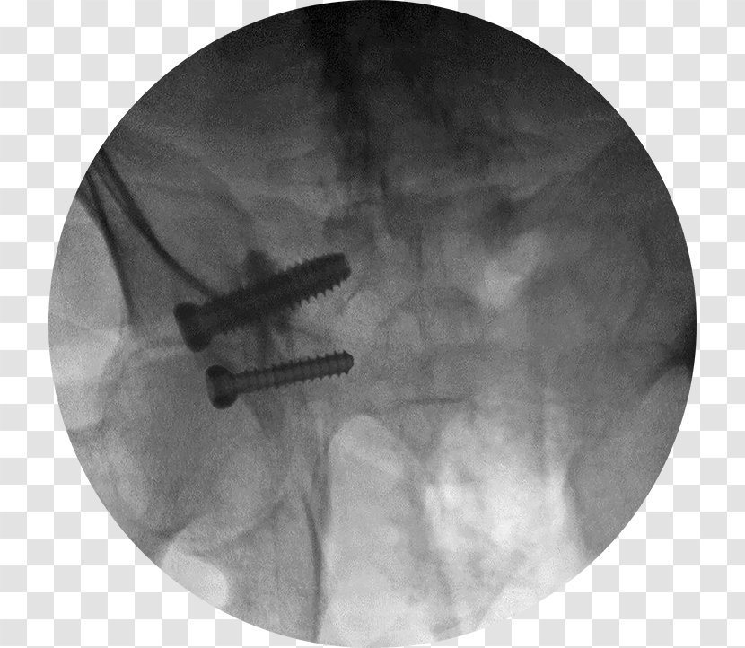 Bone Grafting Joint Implant - Material Transparent PNG