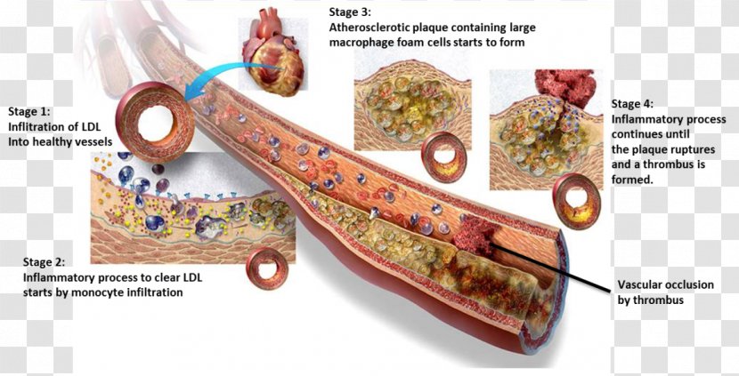 Atherosclerosis Calcification Cardiovascular Disease Artery Endothelium - Health - Dead Heart Transparent PNG