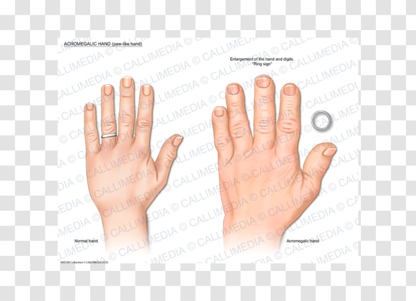 Thumb Acromegaly Hand Endocrinology Growth Hormone - Human Anatomy Transparent PNG