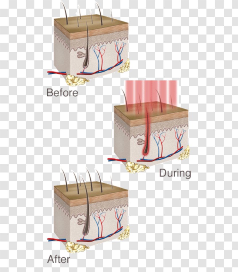 Low-level Laser Therapy Management Of Hair Loss - Box Transparent PNG
