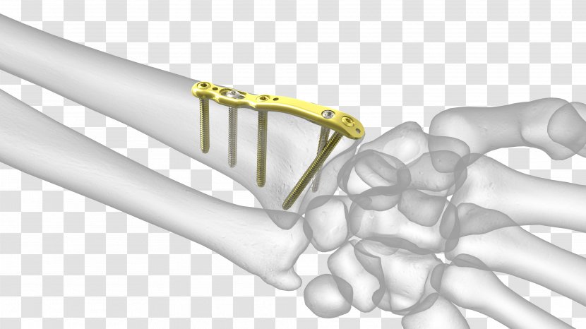 Thumb Distal Radius Fracture Radial Styloid Process Ulnar - Bone Transparent PNG