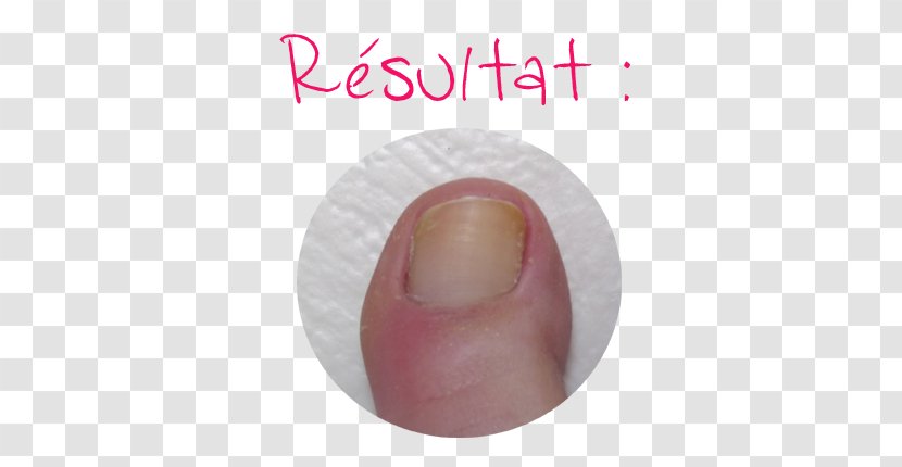Nail Foot Cuticle Cuticule Onychomycosis - Finger - Princess Word Transparent PNG
