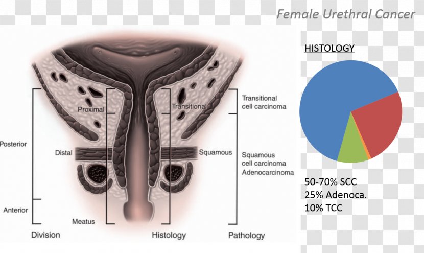 Ureteral Cancer Urethral Bladder - Ureter - Johns Hopkins Hospital Transparent PNG