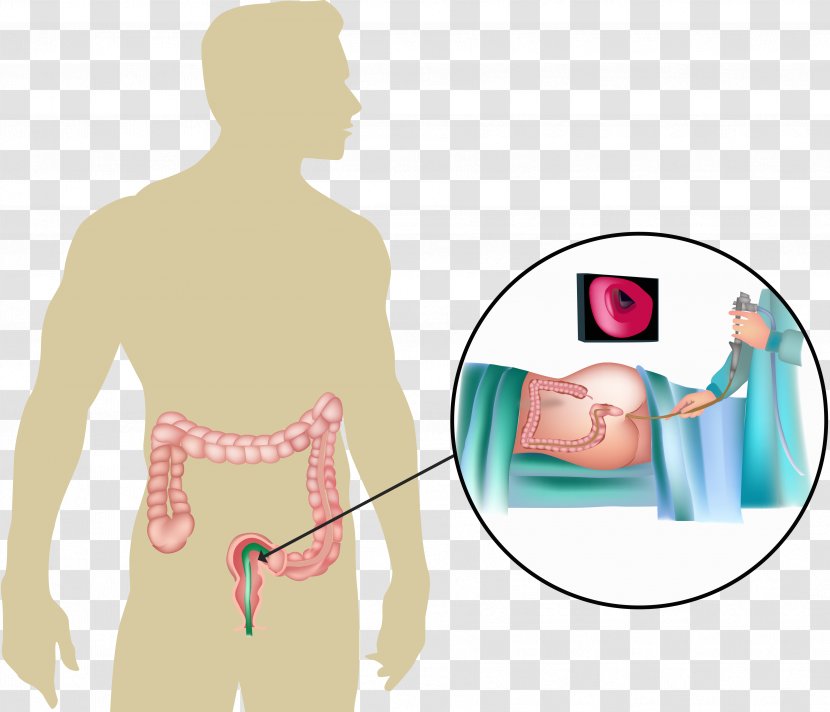 Sigmoidoscopy Sigmoid Colon Large Intestine Colonoscopy Colorectal Cancer - Cartoon Transparent PNG