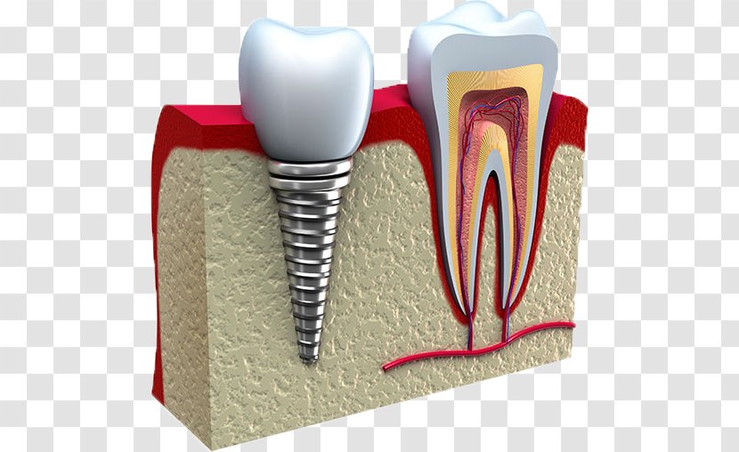 Dental Implant Dentistry Tooth - Heart - Kikuzuki Clinic Transparent PNG