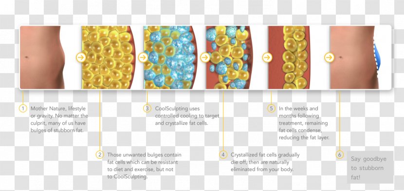 Cryolipolysis Adipocyte Adipose Tissue Surgery Cell - Slimming Transparent PNG