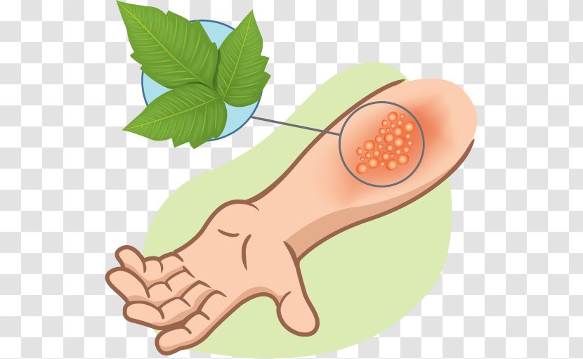 Poison Ivy Western Oak Skin Rash Itch Tecnu - Silhouette - Scar Transparent PNG