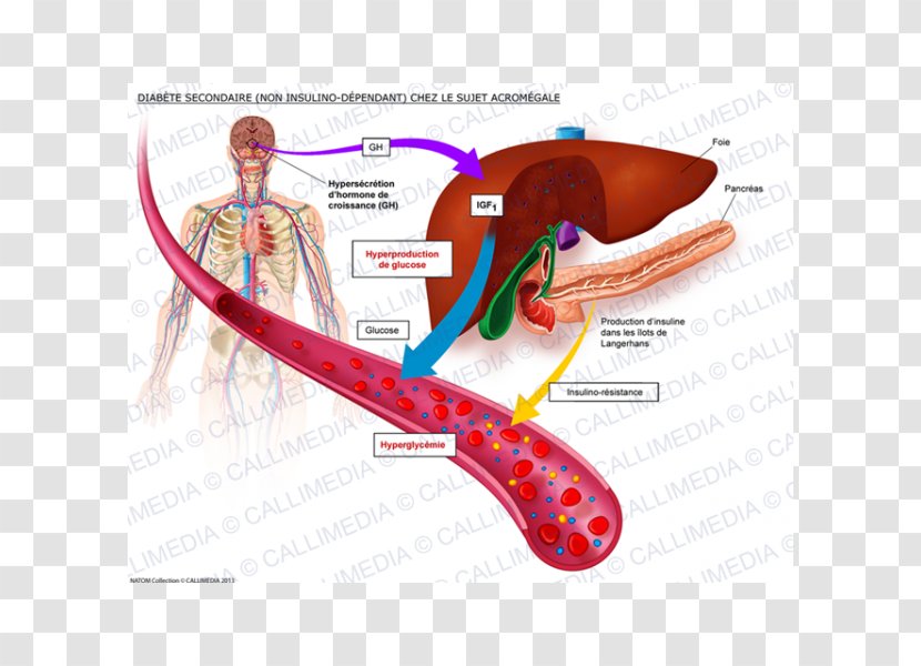 Insulinodependencia Diabetes Mellitus Type 1 2 - Cartoon - Acromegalia Transparent PNG