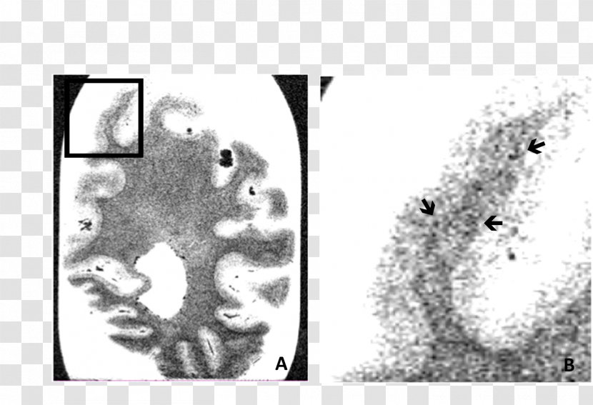 Occipital Lobe Lobes Of The Brain Temporal Cerebral Cortex Parietal - Silhouette - Alzheimer's Disease Transparent PNG