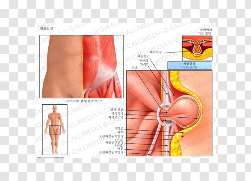 Umbilical Hernia Inguinal Repair Abdominal - Cartoon Transparent PNG