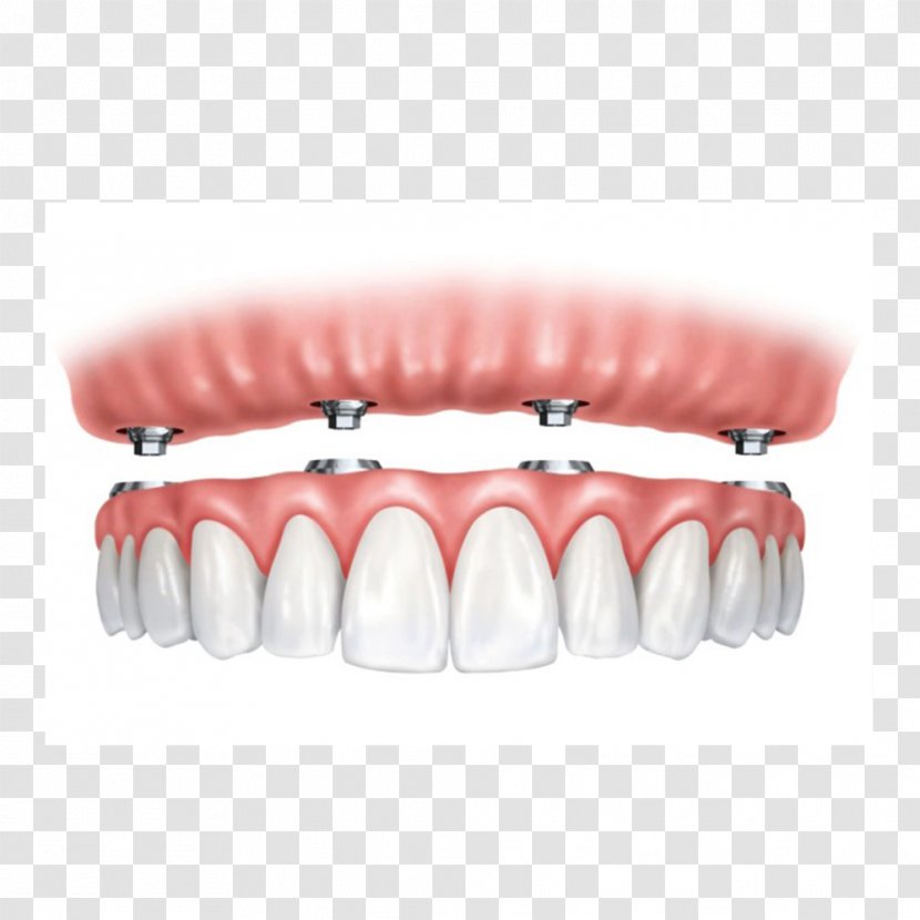 All-on-4 Dental Implant Dentures Dentistry - Therapy Transparent PNG