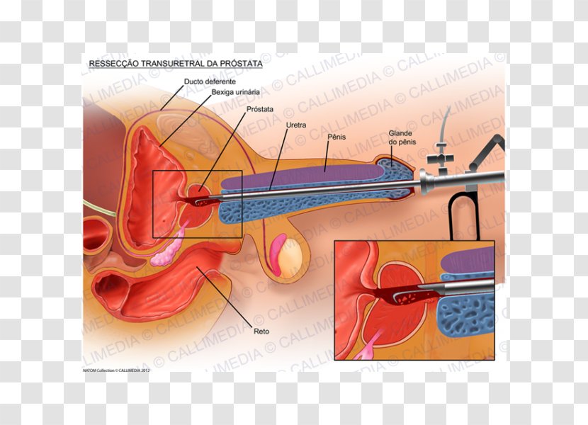 Transurethral Resection Of The Prostate Surgery Cancer - Silhouette - Gland Transparent PNG