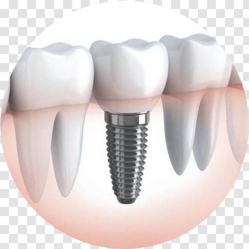 Dental Implant Dentistry Dentures - Cartoon - Crown Transparent PNG