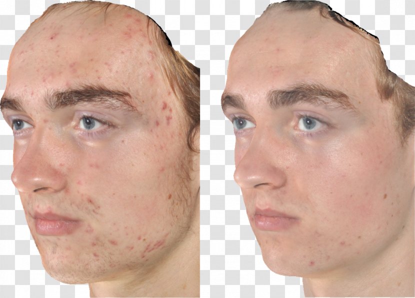 Benzoyl Peroxide Acne Cheek Group Skin - Nose - Scar Transparent PNG