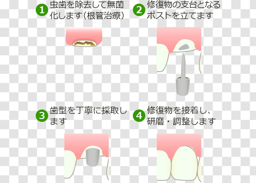 西千葉フラワー歯科医院 【稲毛区・西千葉】 Dentist Crown 3Mix-MP法 Tooth Decay - Therapy Transparent PNG