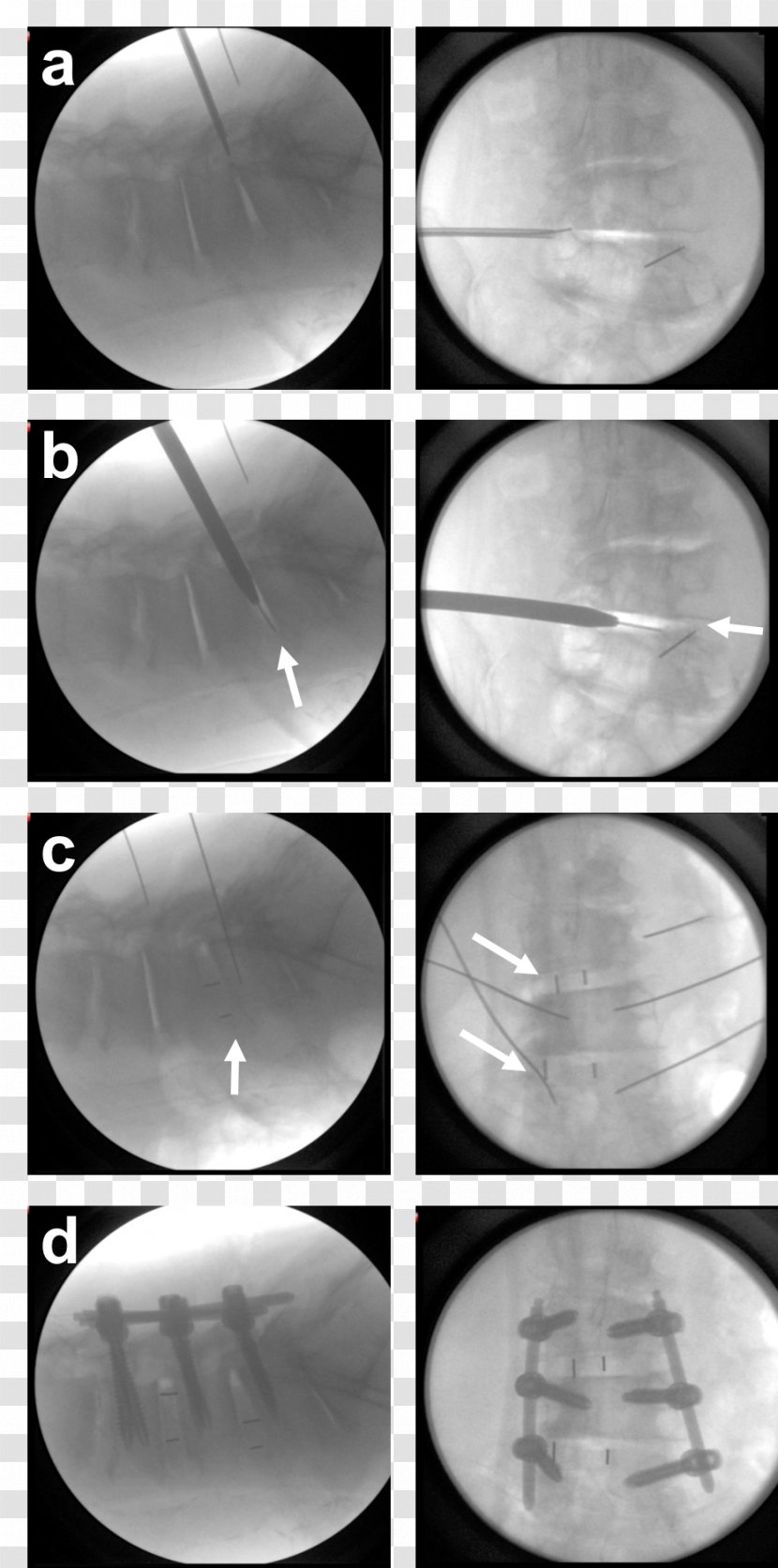 Interbody Fusion Cage Spinal Surgery Lumbar Vertebrae - Decompression - Scoliosis Transparent PNG