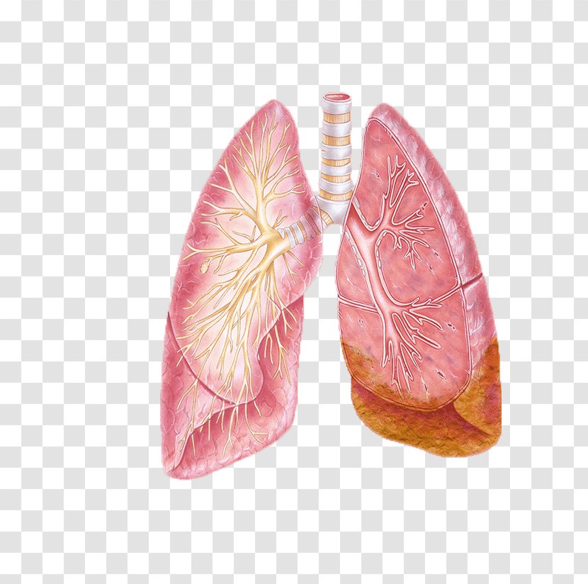 Non-small Cell Lung Cancer Bronchus - Tree - Flower Transparent PNG