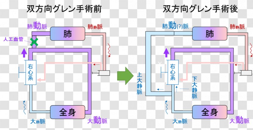 Fukuoka Municipal Children Hospital Hypoplastic Left Heart Syndrome Disease Therapy - Cardiac Surgery Transparent PNG