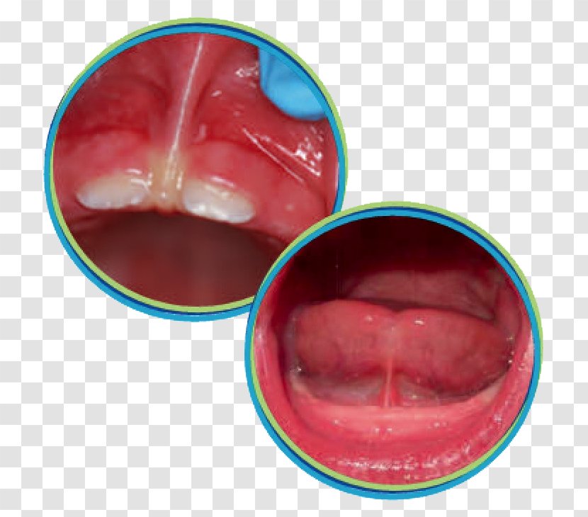 Ankyloglossia Lip Frenectomy Tongue Mouth - Jaw Transparent PNG