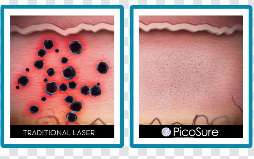 Tattoo Removal L'Arte Della Bellezza Laser Artist - Lip - Treatment Transparent PNG