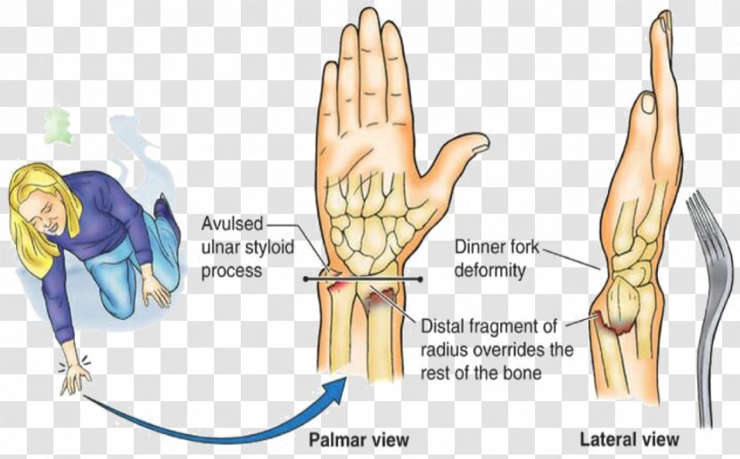 Colles' Fracture Distal Radius Smith's Physical Therapy Bone - Flower - Watercolor Transparent PNG