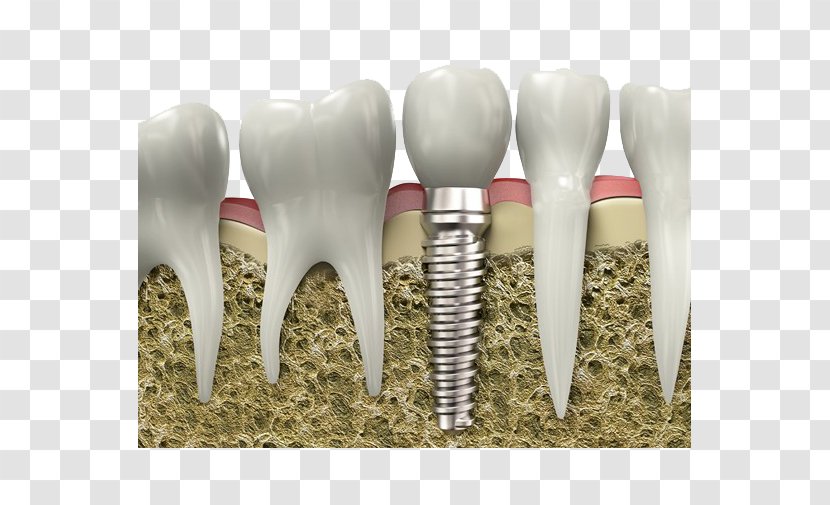 Dentistry Dental Implant Surgery Tooth - Frame - Growing Teeth Picture Material Transparent PNG