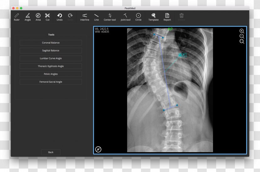 Scoliosis X-ray Vertebral Column Radiography Physical Therapy Transparent PNG