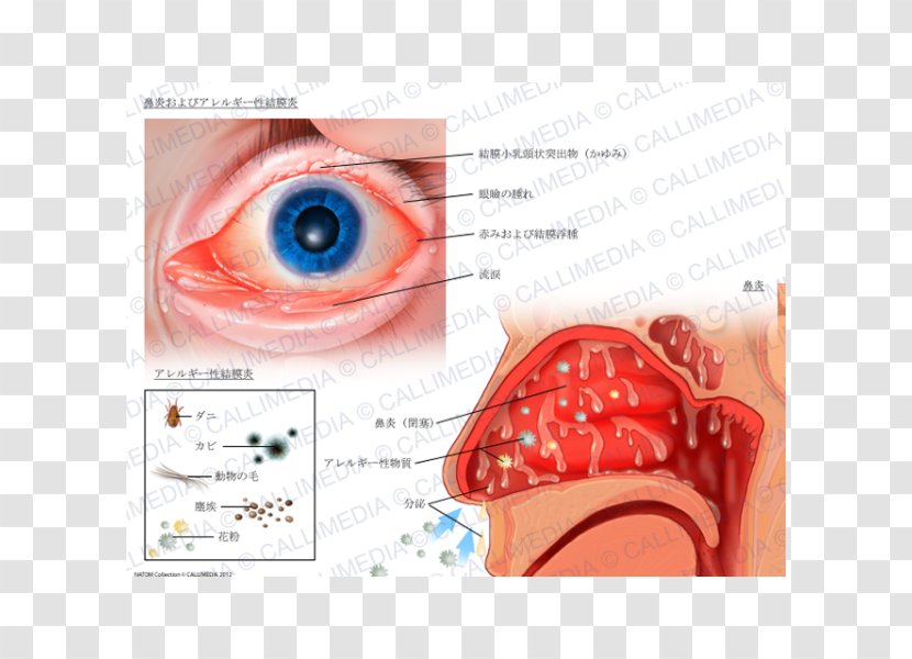 Allergic Conjunctivitis Hay Fever Rhinitis Allergy - Watercolor Transparent PNG