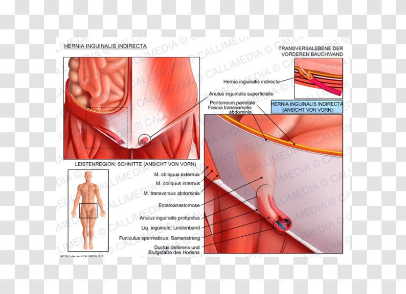 Inguinal Hernia Abdominal External Oblique Muscle Canal Internal - Tree - Frame Transparent PNG