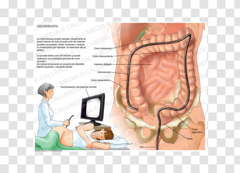 Virtual Colonoscopy Zollinger–Ellison Syndrome Diverticulosis - Silhouette - Chines Transparent PNG