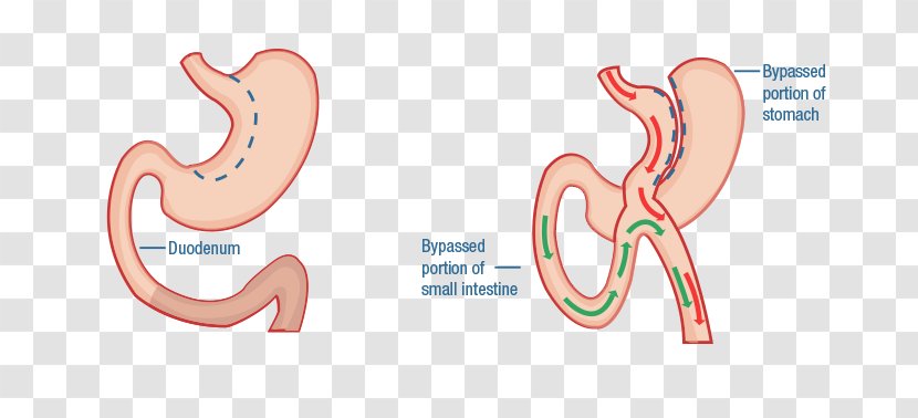 Duodenal Switch Bariatric Surgery Duodenum Gastric Bypass - Silhouette - Diabetes Mellitus Type 2 Transparent PNG