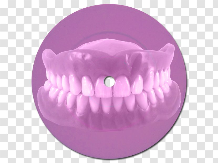 Dentures Dentistry Bridge Dental Implant - Dentist Transparent PNG
