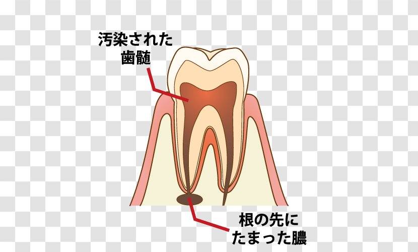 Dentist 歯科 Root Canal Tooth Decay Endodontic Therapy - Silhouette - Captions Transparent PNG