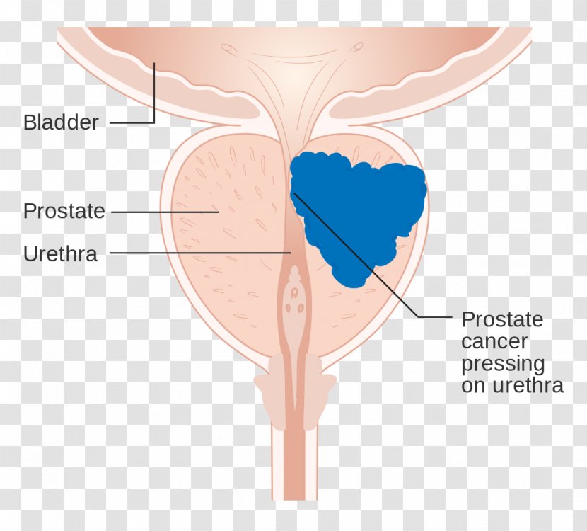 Prostate Cancer Gland Urology - Flower - Health Transparent PNG