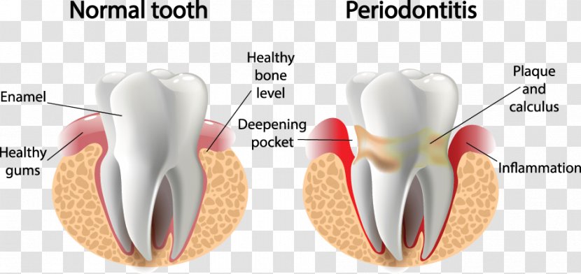 Periodontal Disease Gums Gingivitis Periodontology Dentistry - Silhouette - Health Transparent PNG