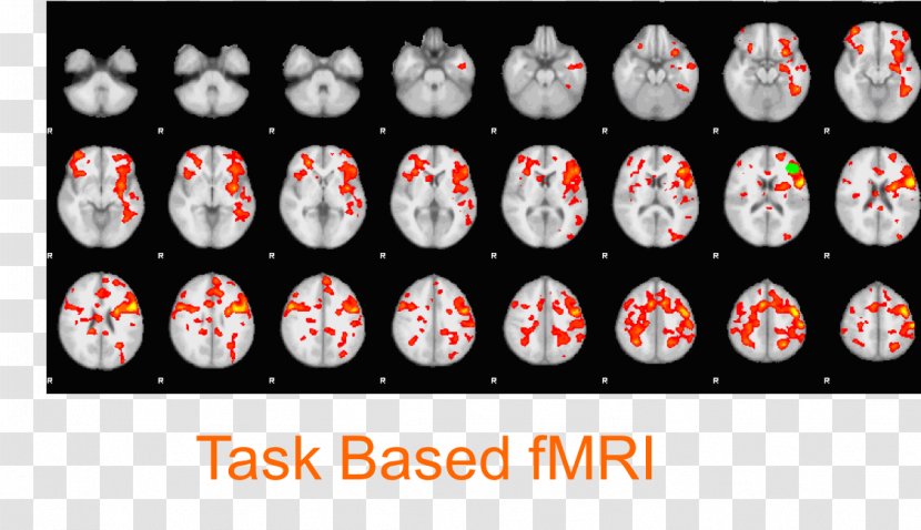 Functional Magnetic Resonance Imaging Brain Default Mode Network Neuroimaging Transparent PNG