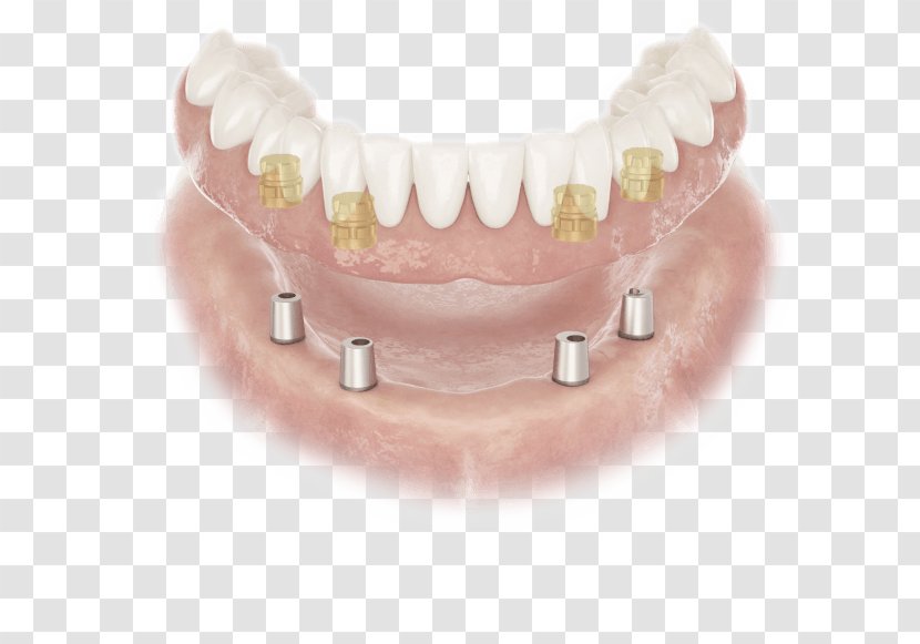Abutment Dentures Dental Implant Dentist Edentulism - Dentistry - Removable Partial Denture Transparent PNG