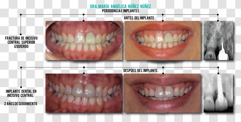Tooth Dental Implant Dentures Maxilla - Bone Transparent PNG