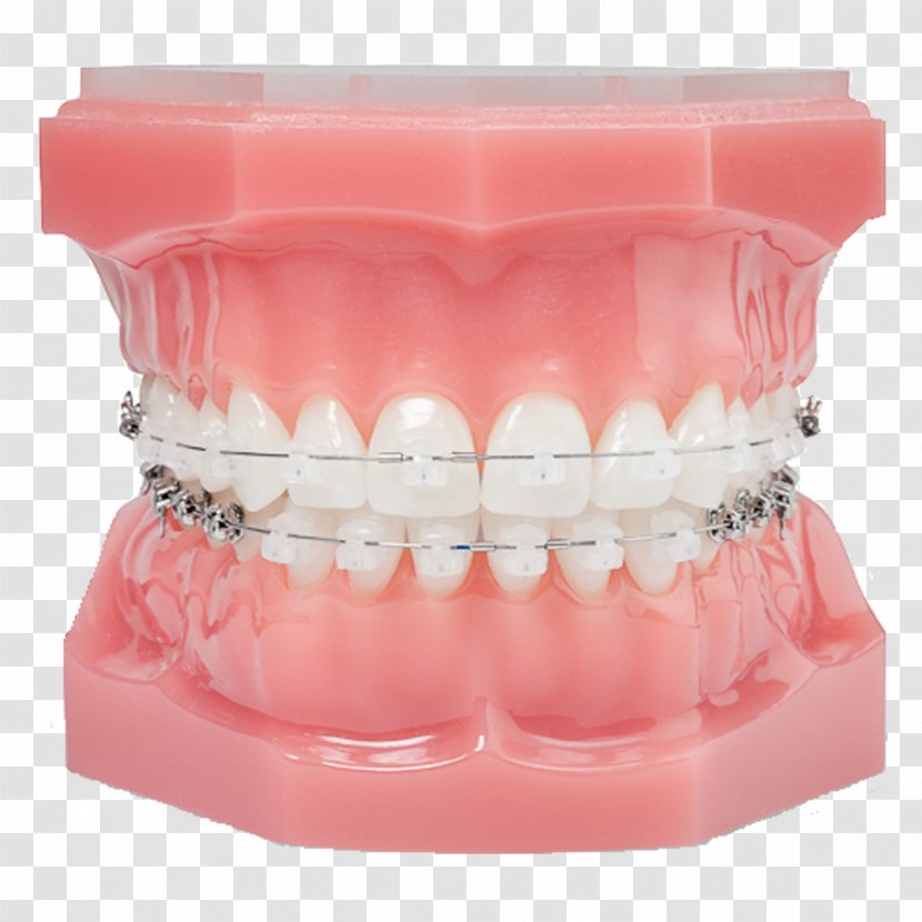 Damon System Orthodontics Dental Braces Clear Aligners Self-ligating Bracket - Patient Transparent PNG