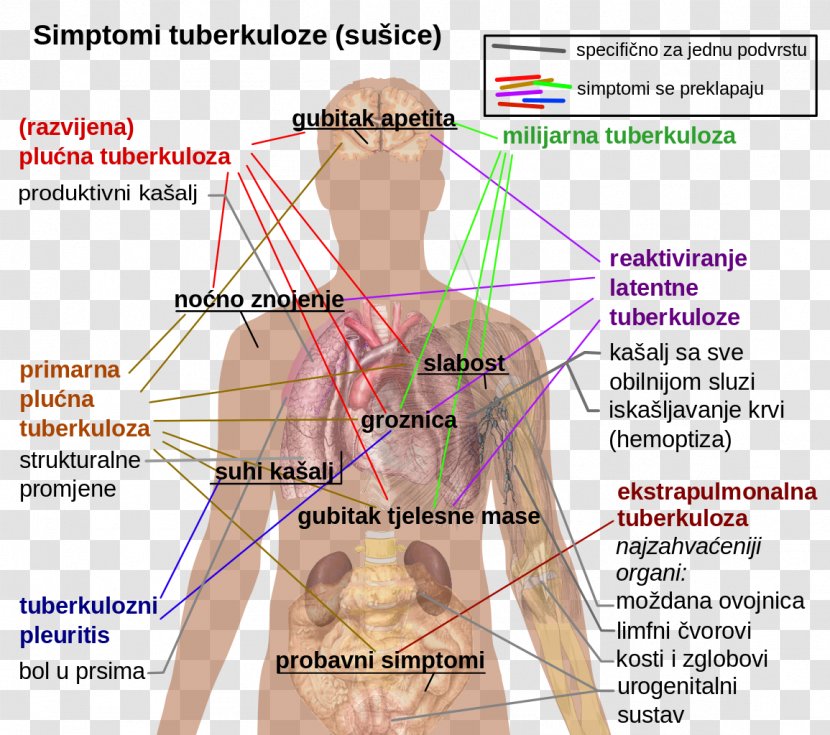 Latent Tuberculosis Infection Symptom Disease - Tree - Health Transparent PNG