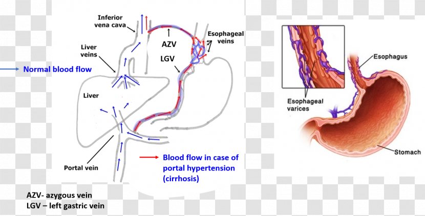 Esophageal Varices Esophagus Cirrhosis Portal Hypertension Cancer - Frame - Cranial Nerve Transparent PNG
