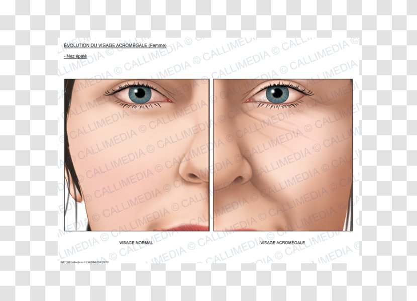 Acromegaly Nose Face Growth Hormone Endocrinology - Eyelash Extensions Transparent PNG