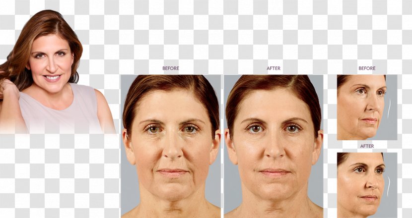Eyebrow Injectable Filler Non-surgical Rhinoplasty Nose - Hyaluronic Acid Transparent PNG