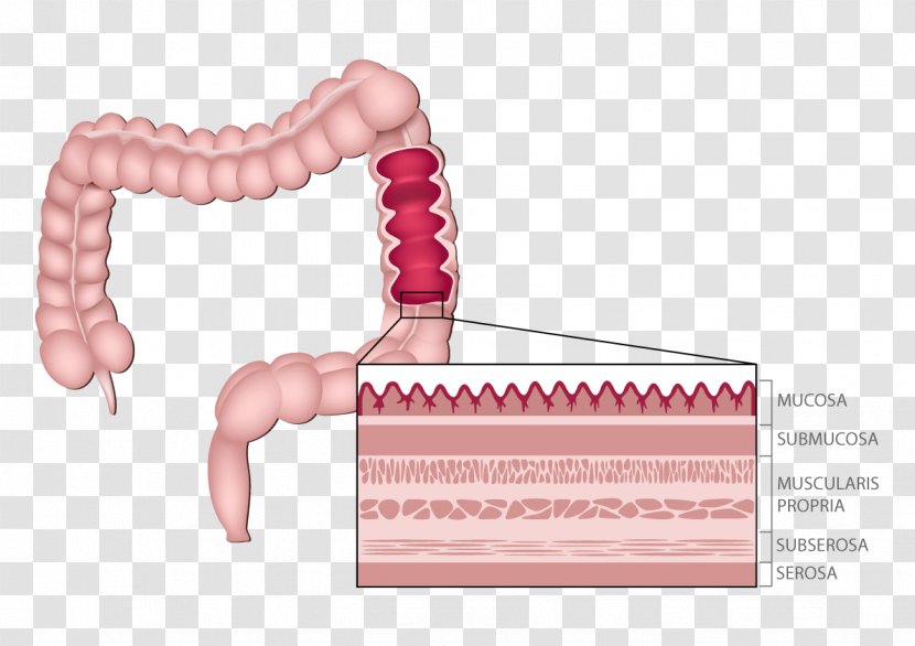 Hereditary Nonpolyposis Colorectal Cancer Large Intestine Surgery - Watercolor - Anatomy Transparent PNG