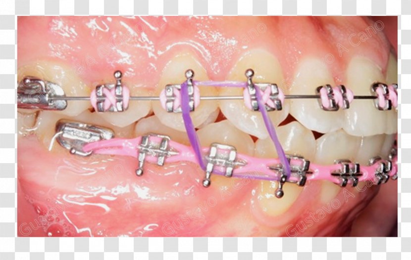 Orthodontics Dentistry Dental Braces Tooth Elasticity - Chin - Orthodontic Transparent PNG