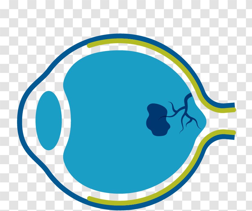 Exudative Macular Degeneration Macula Of Retina Eye - Aqua Transparent PNG