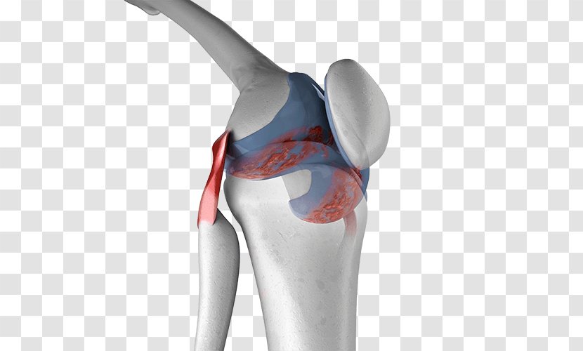Knee Pain Arthritic Arthritis Joint - Clipart Transparent PNG