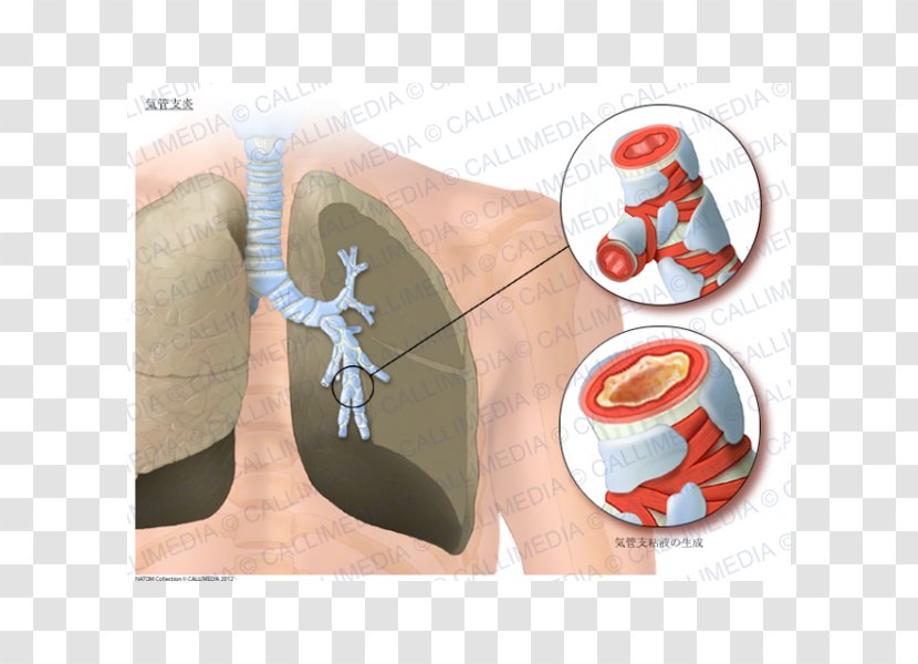 Acute Bronchitis Asthma Lung Bronchiolitis Bronchus - Silhouette - Bronchial Transparent PNG